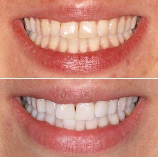 Teeth whitening 16 carbamide peroxide how long