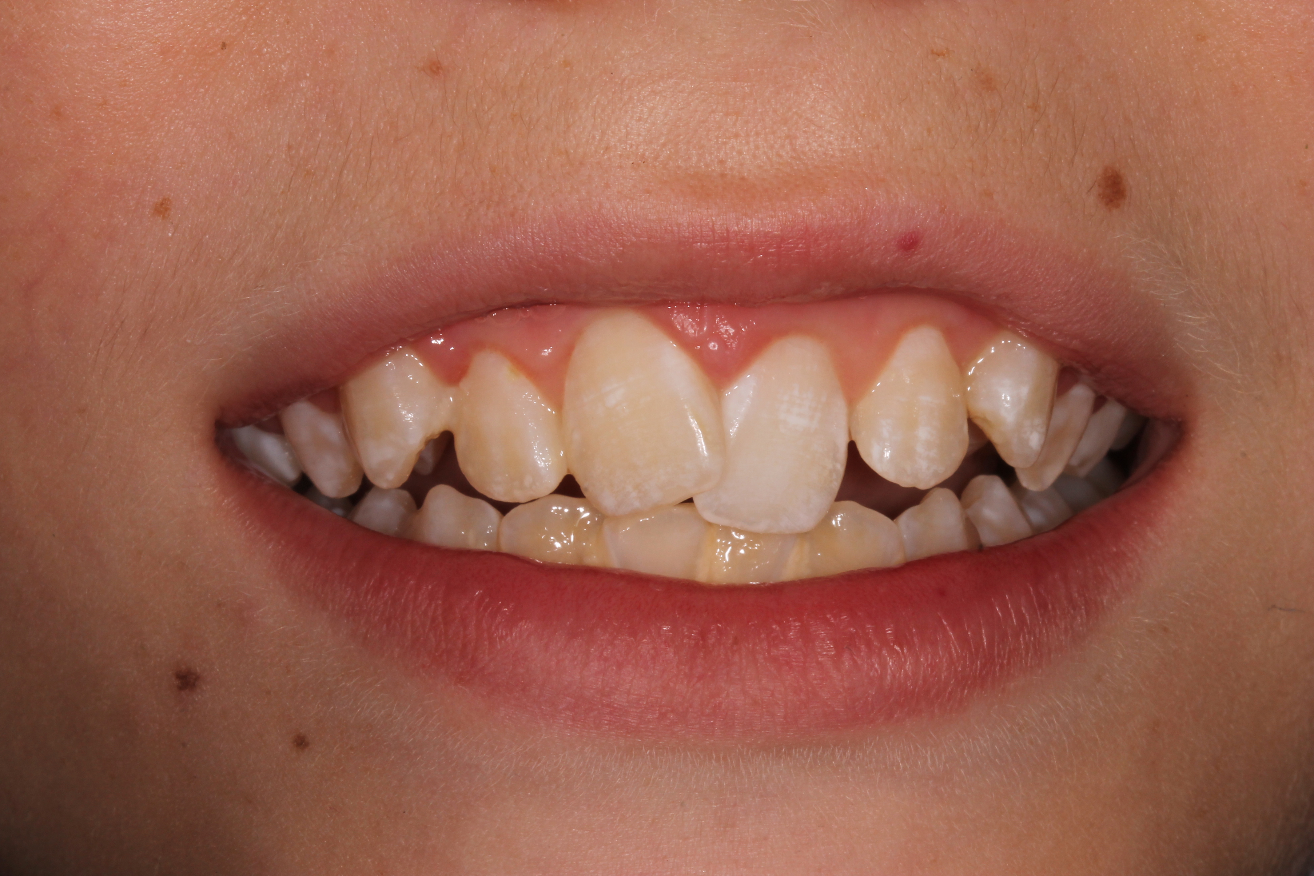 Under 18's & Teeth Whitening - Enlighten Smiles Blog