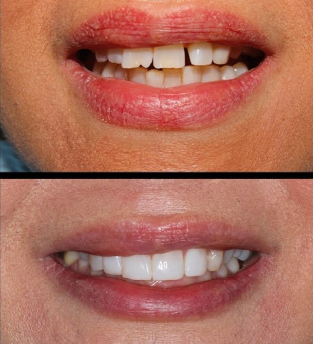 What's the difference between amalgam and composite fillings