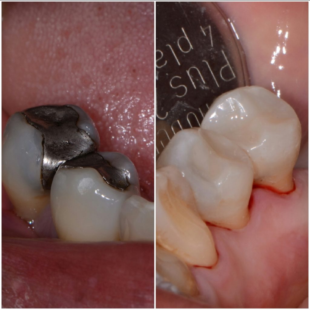 What's the difference between amalgam and composite fillings? Enlighten Smiles Blog