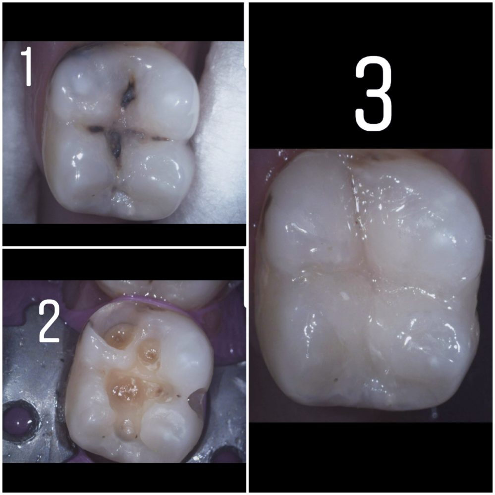 What's the difference between amalgam and composite fillings ...