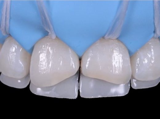 The Renamel composite system