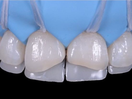 The Renamel composite system
