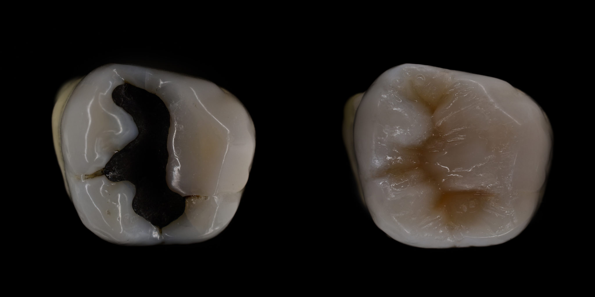 What's the difference between amalgam and composite fillings