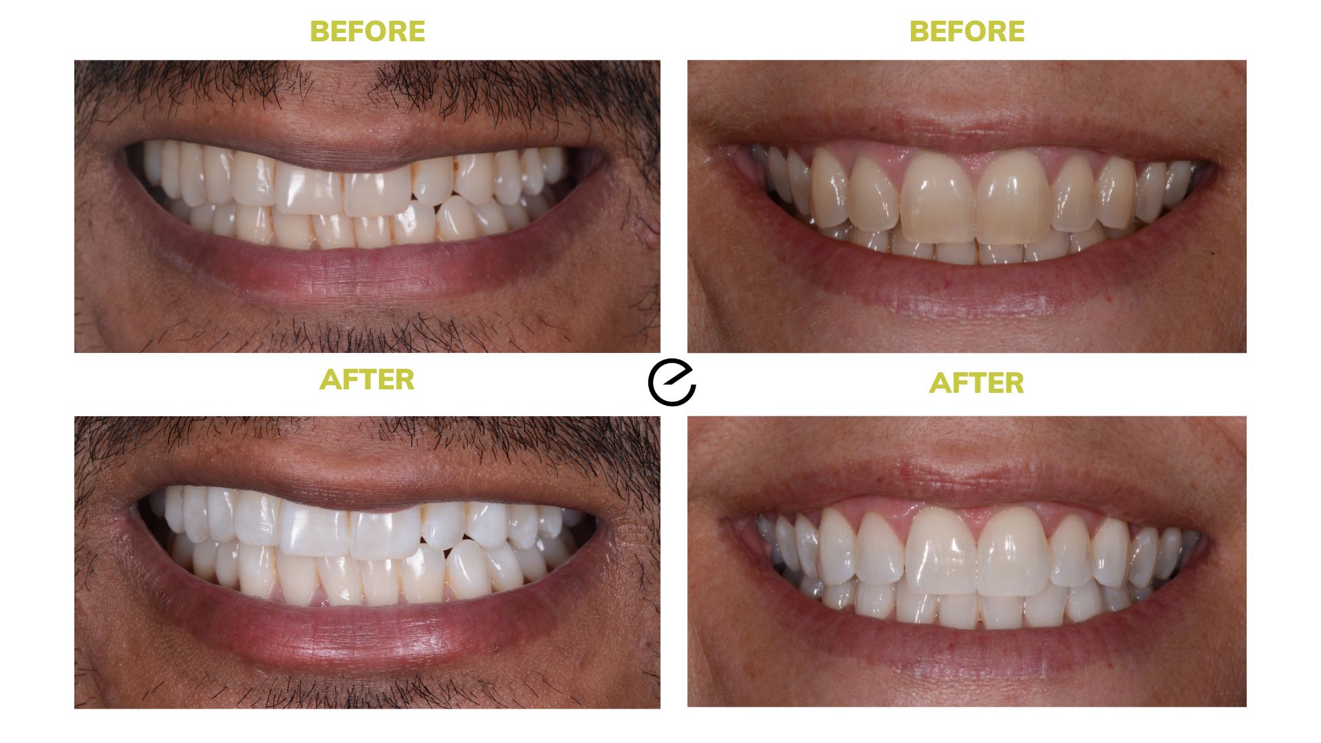 FAQ's on Enlighten Whitening Patient