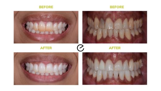 FAQ's on Enlighten Whitening Patient