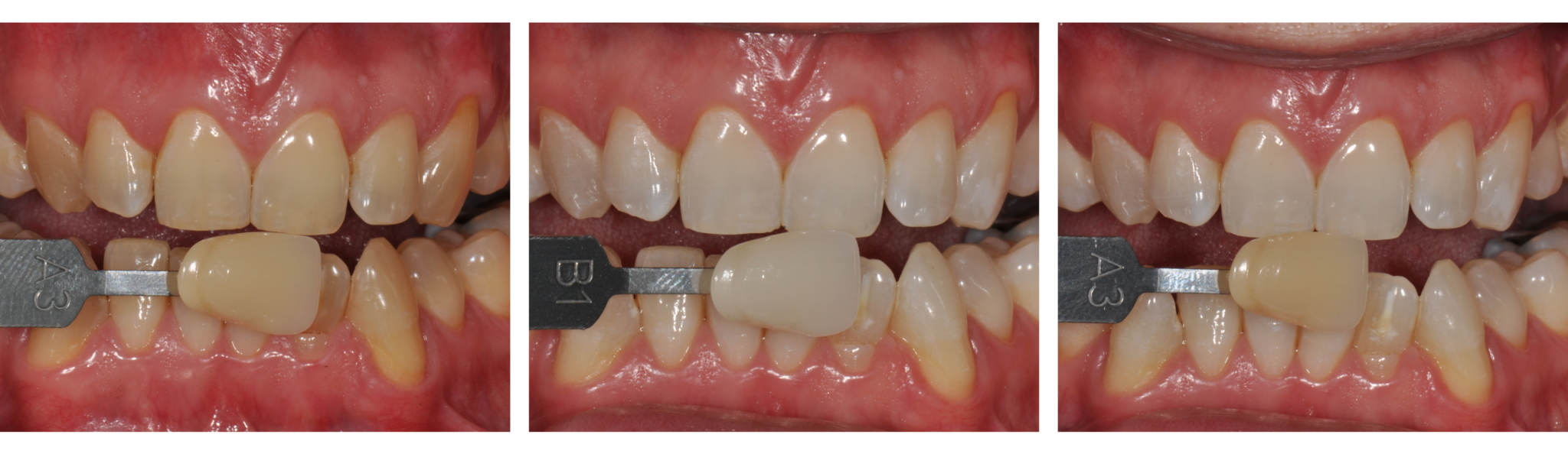 How To Treat Difficult Whitening Cases