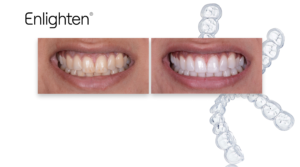 How To Treat Difficult Whitening Cases