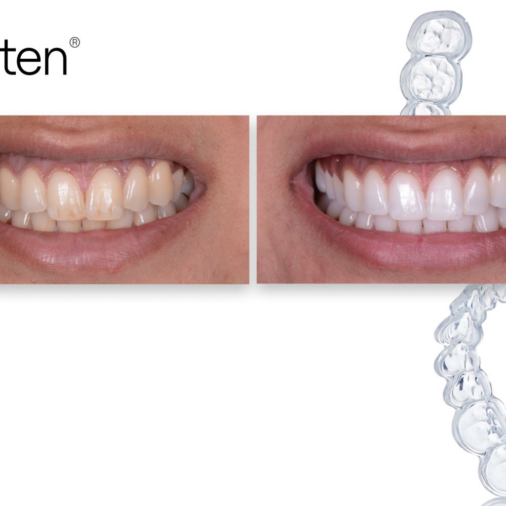 How To Treat Difficult Whitening Cases – Enlighten Smiles Blog